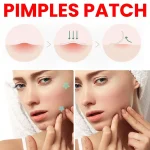 200pcs Star Acne Pimple Patches Colorful Breathable Removal Pimple Absorb Secretions Anti Infection Concealer Makeup Skin Care 2