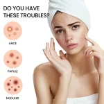 200pcs Star Acne Pimple Patches Colorful Breathable Removal Pimple Absorb Secretions Anti Infection Concealer Makeup Skin Care 3
